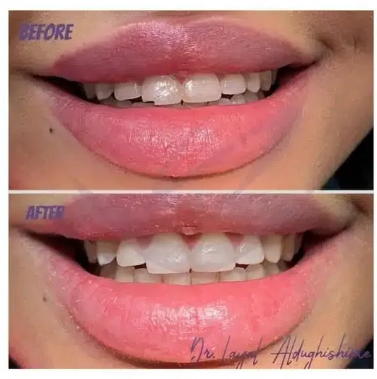 Cavity filling before and after at Lasting Smile