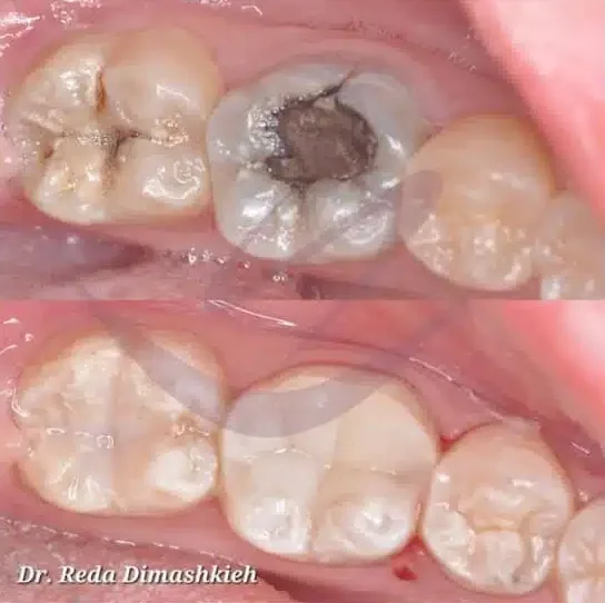 Restorative dentistry before and after at Lasting Smile