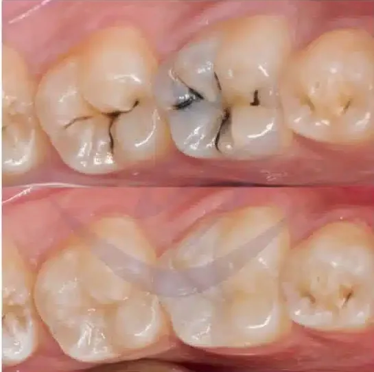 Smile makeover before and after at Lasting Smile