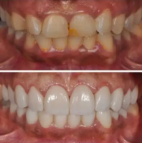 Teeth whitening before and after at Lasting Smile