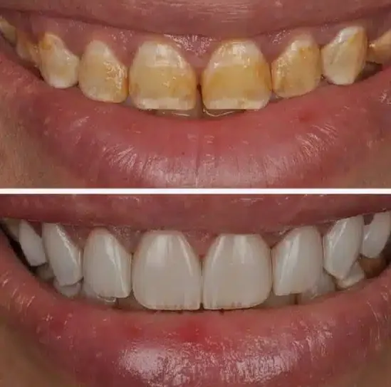 Veneers before and after at Lasting Smile