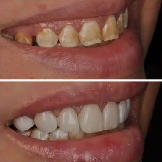 Cosmetic dentistry before and after at Lasting Smile