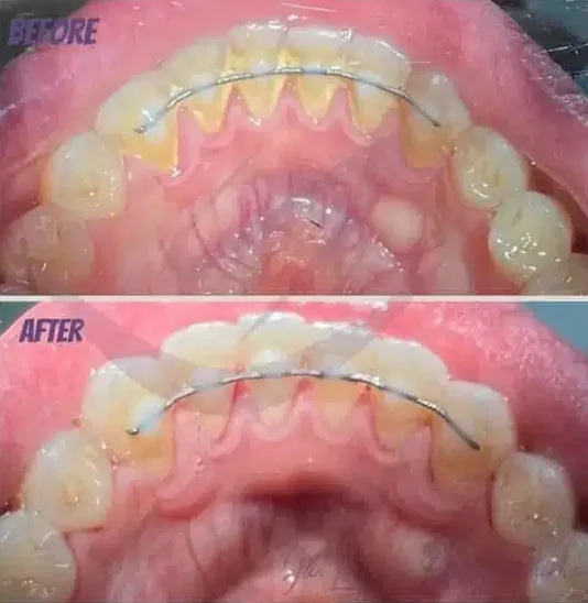 Orthodontic retainer before and after at Lasting Smile